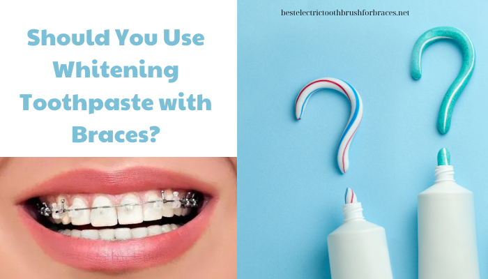 Should You Use Whitening Toothpaste with Braces?